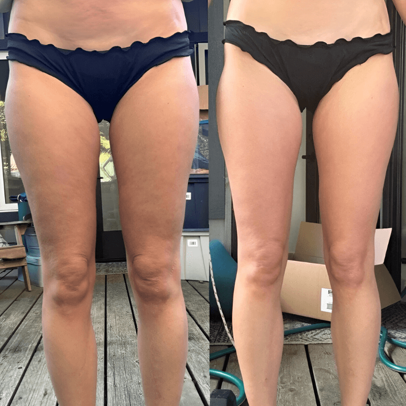 Glamcare™ Anti Cellulite Massager