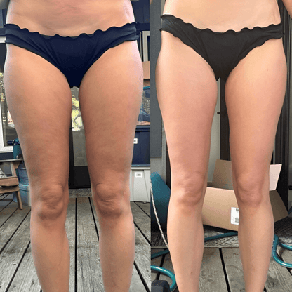 Glamcare™ Anti Cellulite Massager